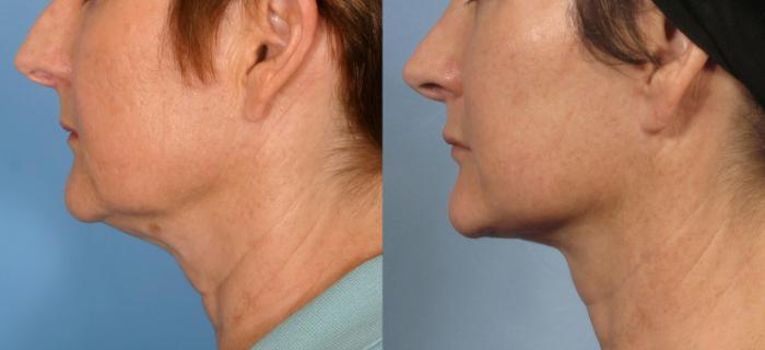 Before & After Facelift Case 182 View #3 View in Naples and Ft. Myers, FL