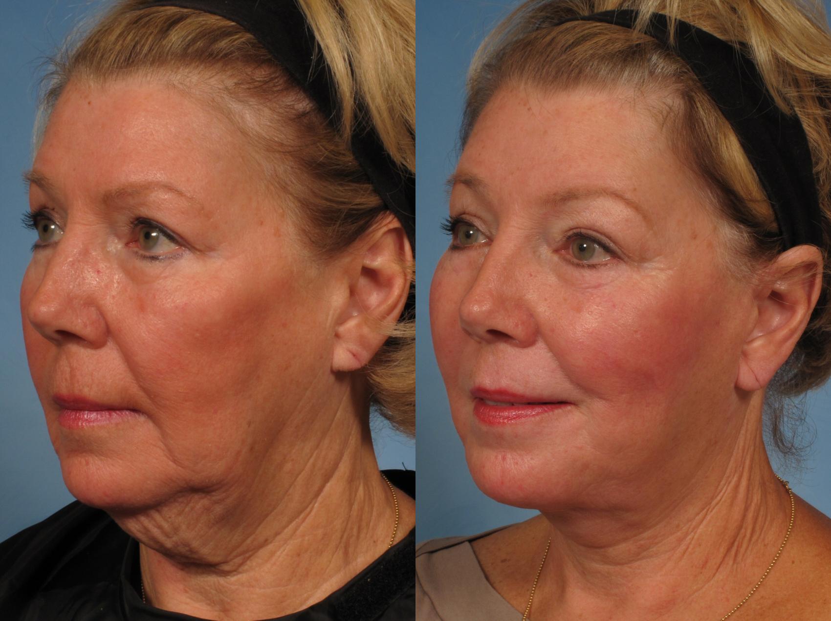 Before & After Facelift Case 183 View #5 View in Naples and Ft. Myers, FL