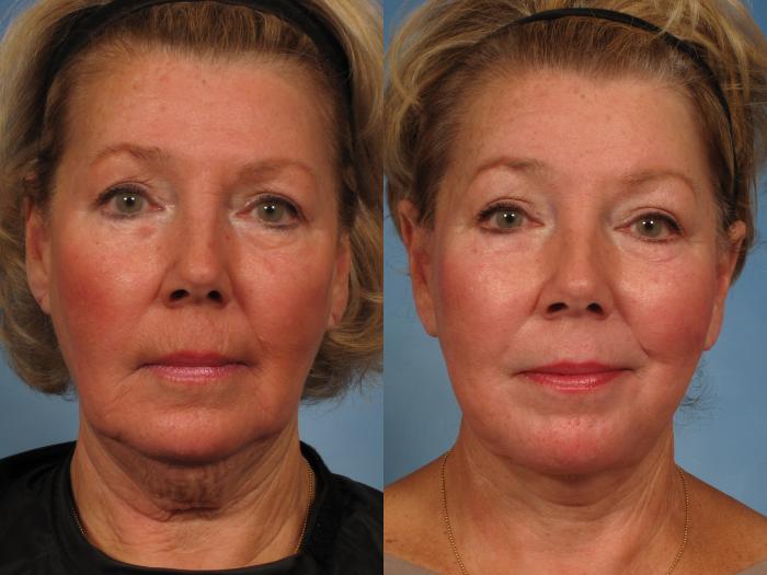 Before & After Facelift Case 183 View #6 View in Naples and Ft. Myers, FL
