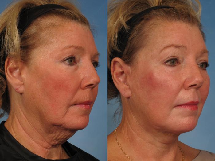 Before & After Facelift Case 183 View #7 View in Naples and Ft. Myers, FL