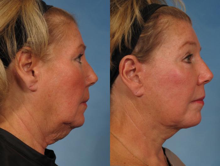 Before & After Facelift Case 183 View #8 View in Naples and Ft. Myers, FL