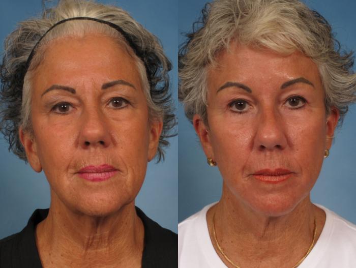 Before & After Facelift Case 185 View #1 View in Naples and Ft. Myers, FL