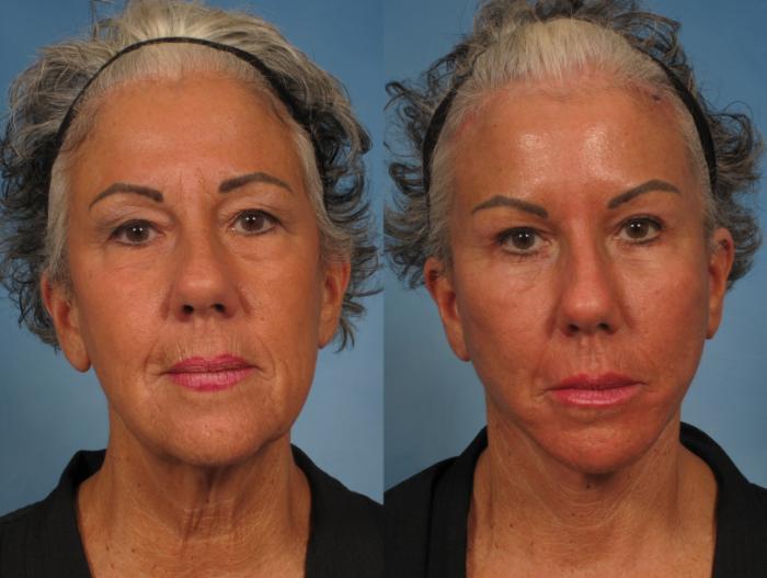 Before & After Facelift Case 185 View #2 View in Naples and Ft. Myers, FL