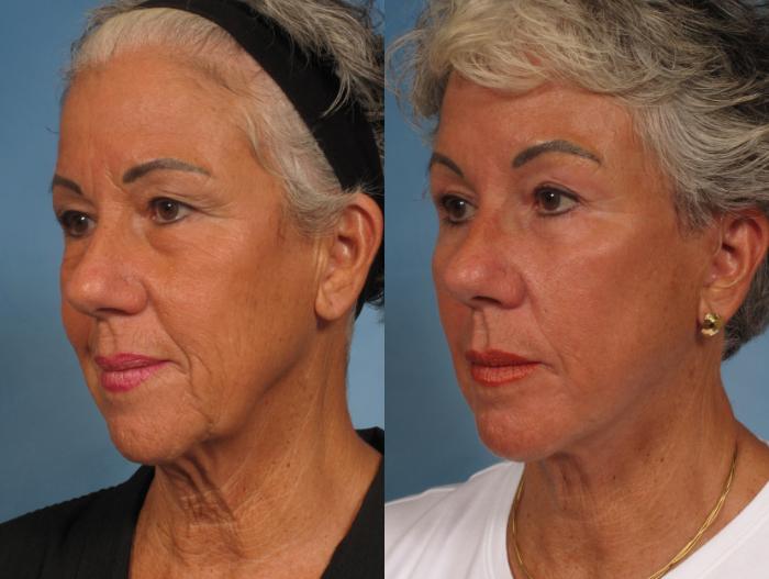 Before & After Facelift Case 185 View #3 View in Naples and Ft. Myers, FL