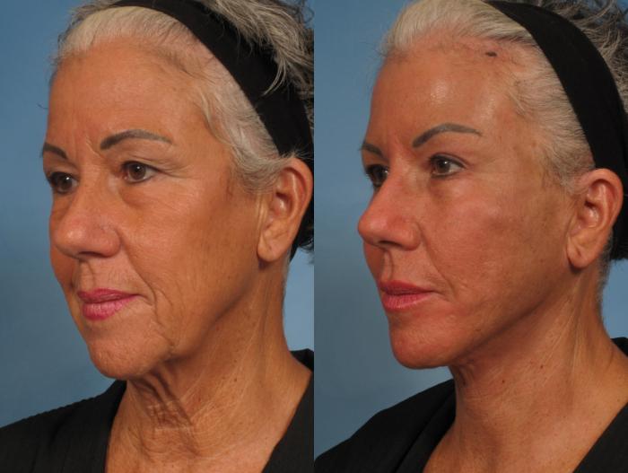 Before & After Facelift Case 185 View #4 View in Naples and Ft. Myers, FL