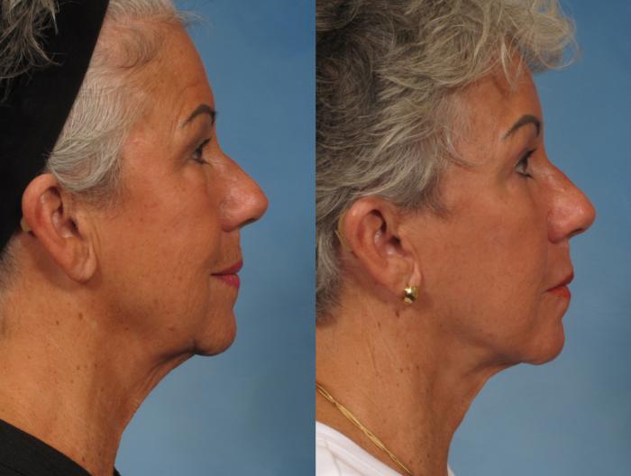 Before & After Facelift Case 185 View #5 View in Naples and Ft. Myers, FL