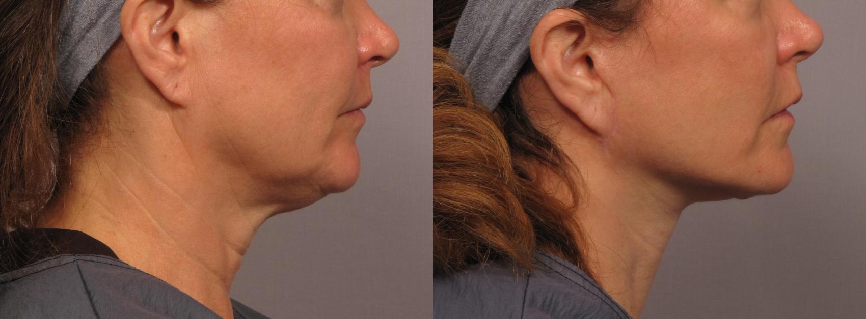 Before & After Facelift Case 300 View #1 View in Naples and Ft. Myers, FL
