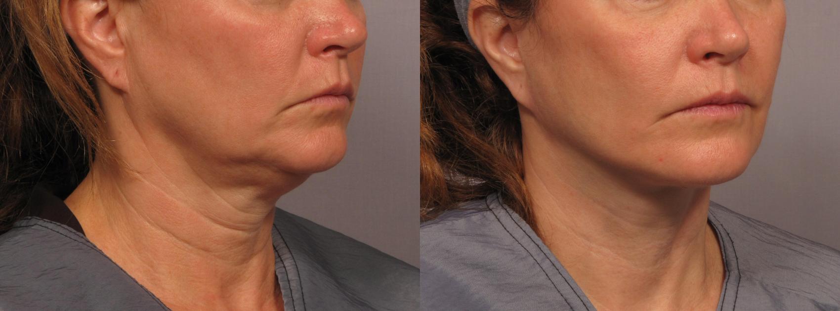 Before & After Facelift Case 300 View #2 View in Naples and Ft. Myers, FL