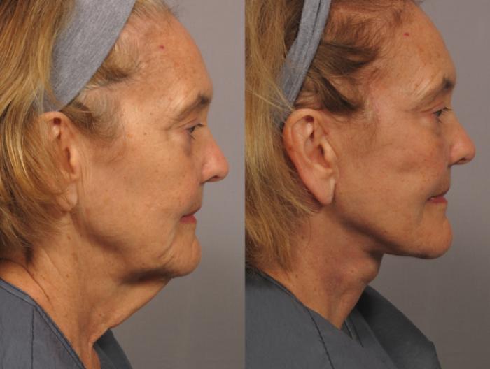 Before & After Facelift Case 306 View #1 View in Naples and Ft. Myers, FL