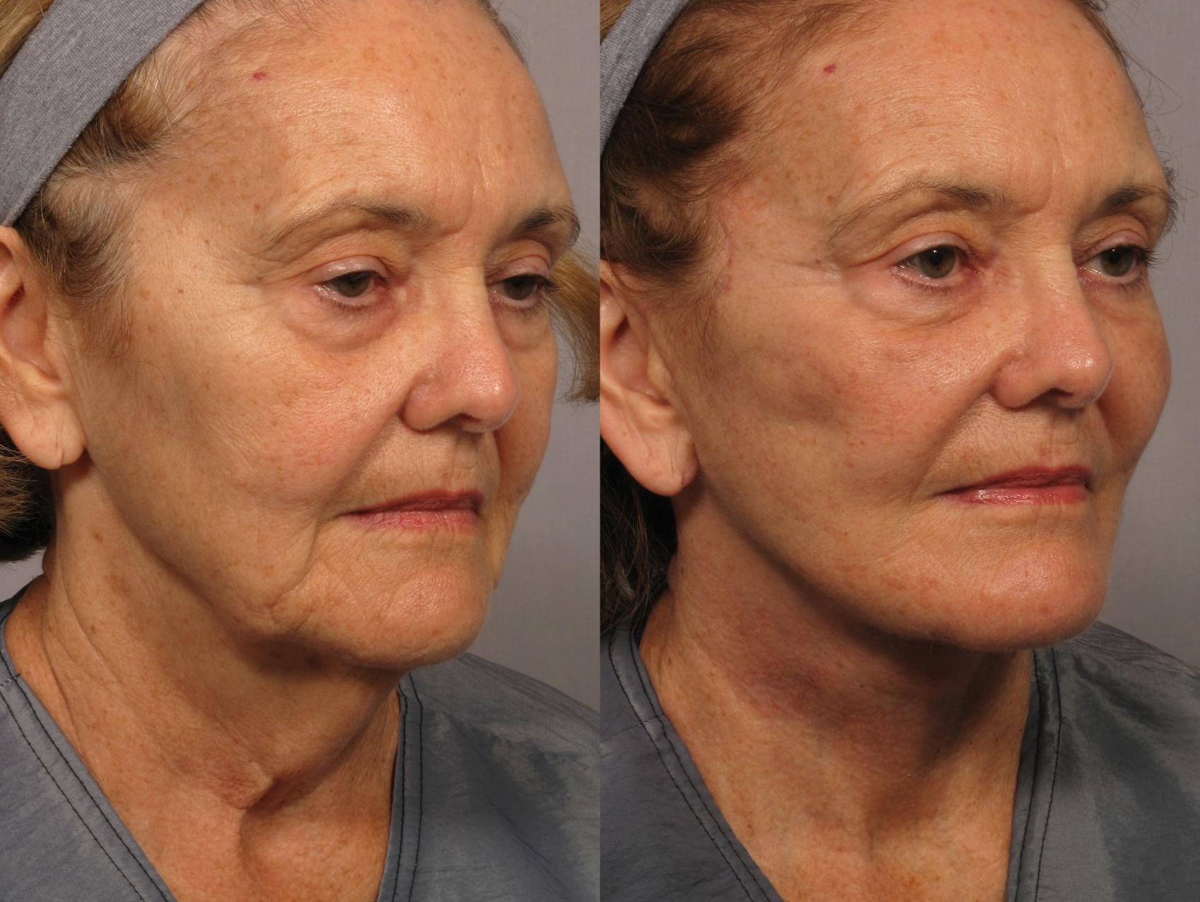 Before & After Facelift Case 306 View #2 View in Naples and Ft. Myers, FL