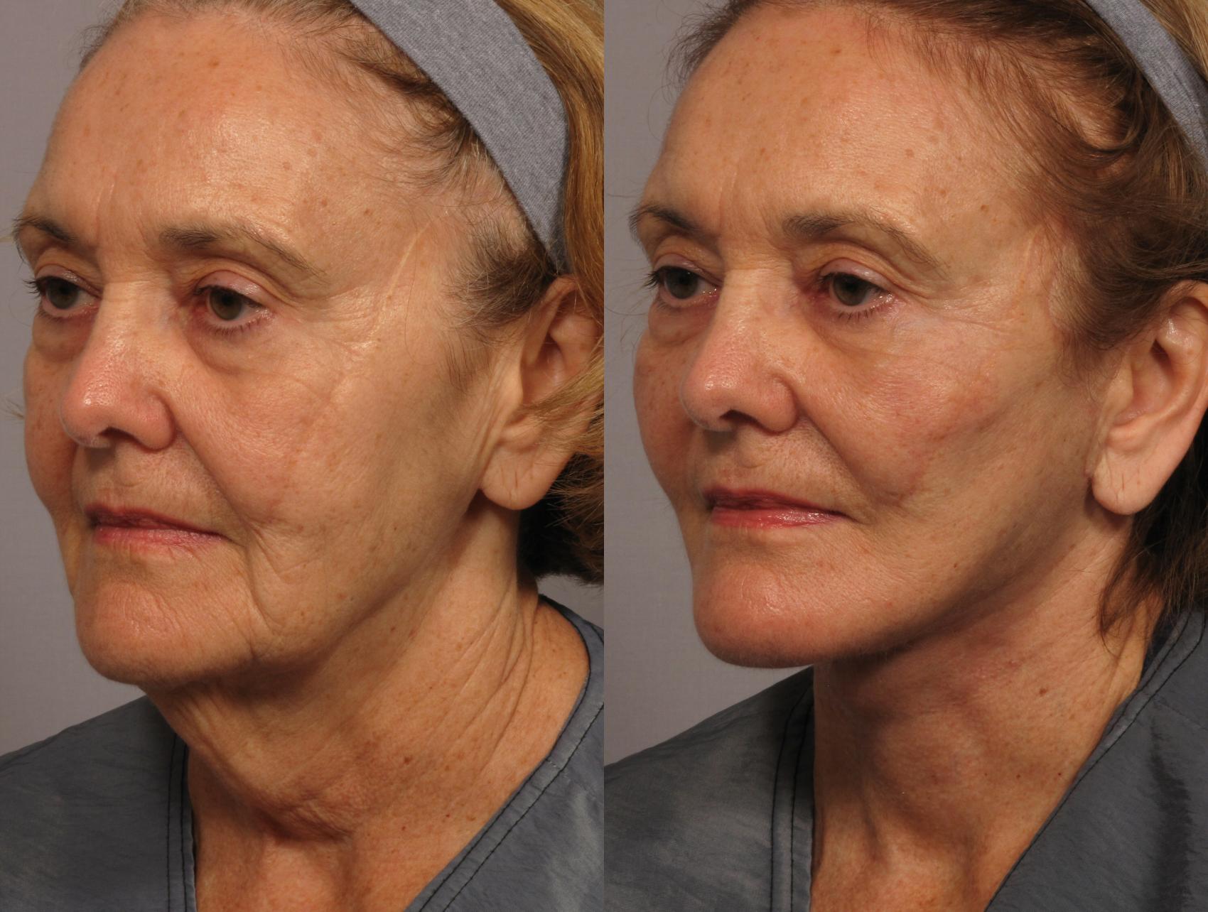 Before & After Facelift Case 306 View #3 View in Naples and Ft. Myers, FL