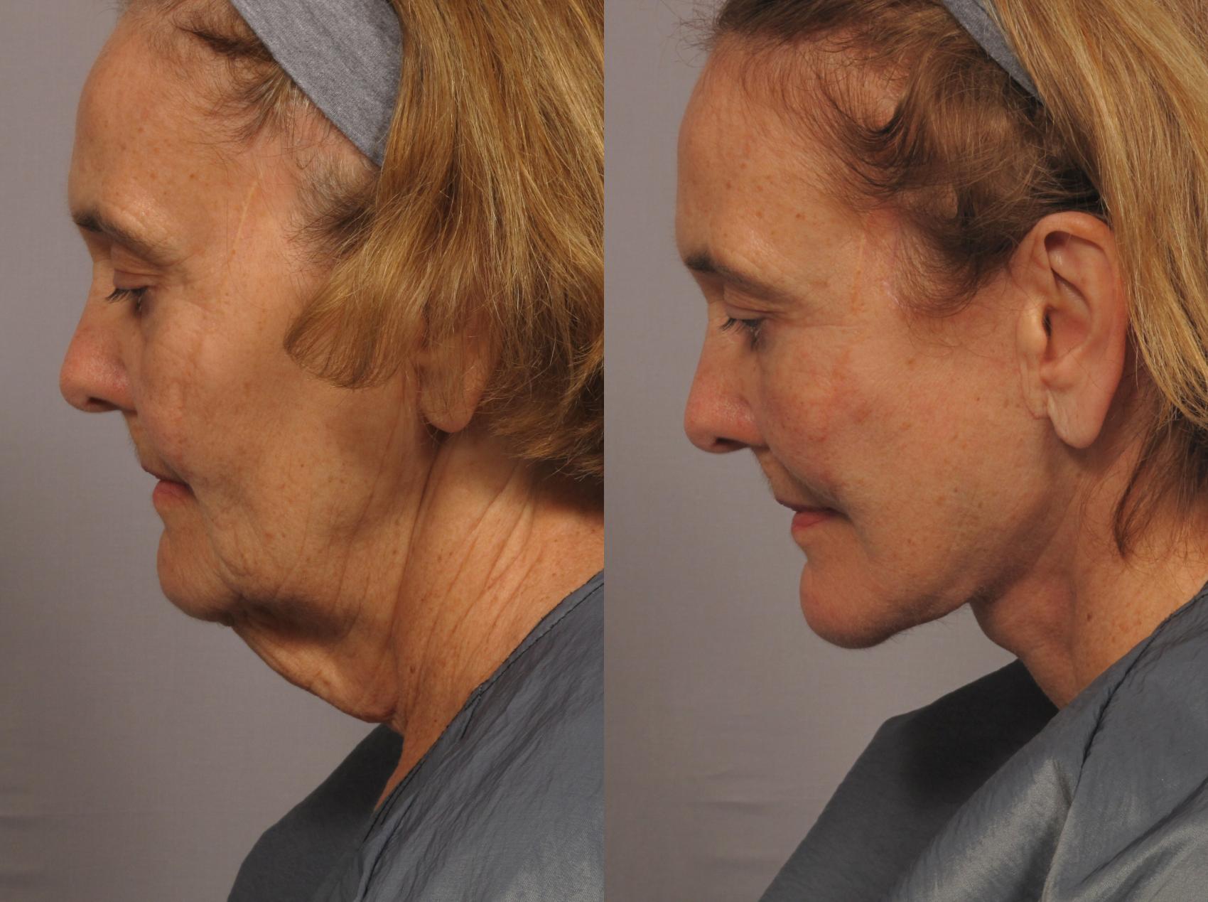 Before & After Facelift Case 306 View #4 View in Naples and Ft. Myers, FL