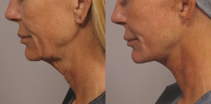 Before & After Facelift Case 333 View #1 View in Naples and Ft. Myers, FL