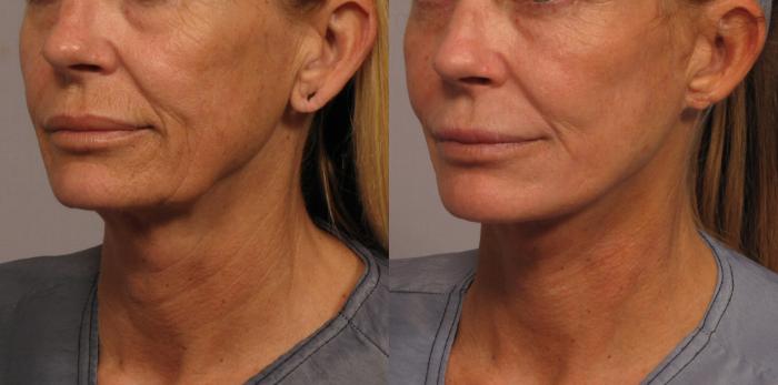 Before & After Facelift Case 333 View #2 View in Naples and Ft. Myers, FL