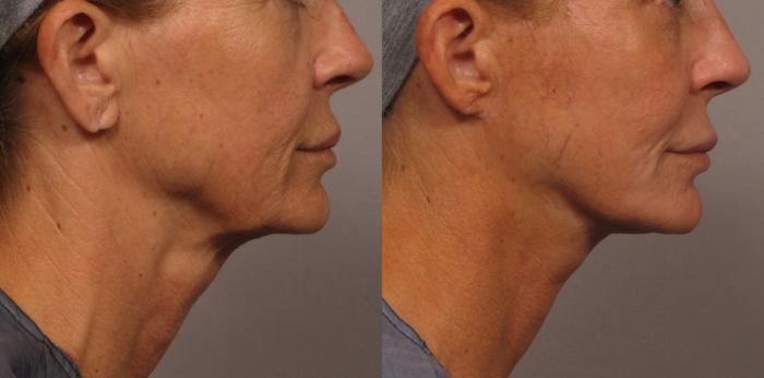 Before & After Facelift Case 333 View #3 View in Naples and Ft. Myers, FL