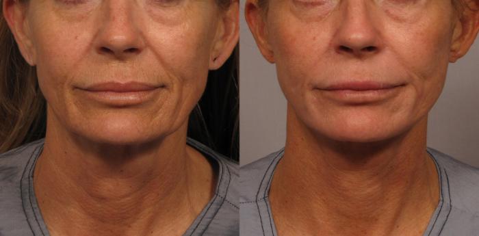Before & After Facelift Case 333 View #4 View in Naples and Ft. Myers, FL