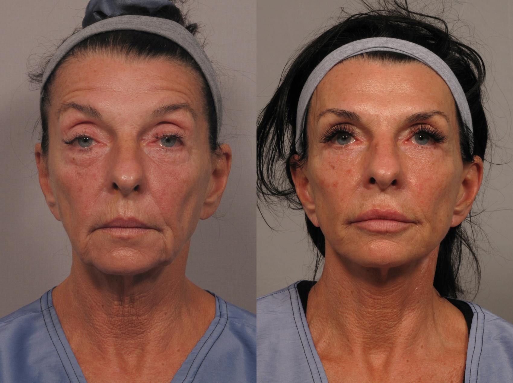 Pre-op frontal photo of facelift patient in Naples, Florida by Dr. Kent Hasen