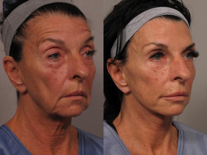 Pre-op Right Oblique photo of facelift patient in Naples, Florida by Dr. Kent Hasen