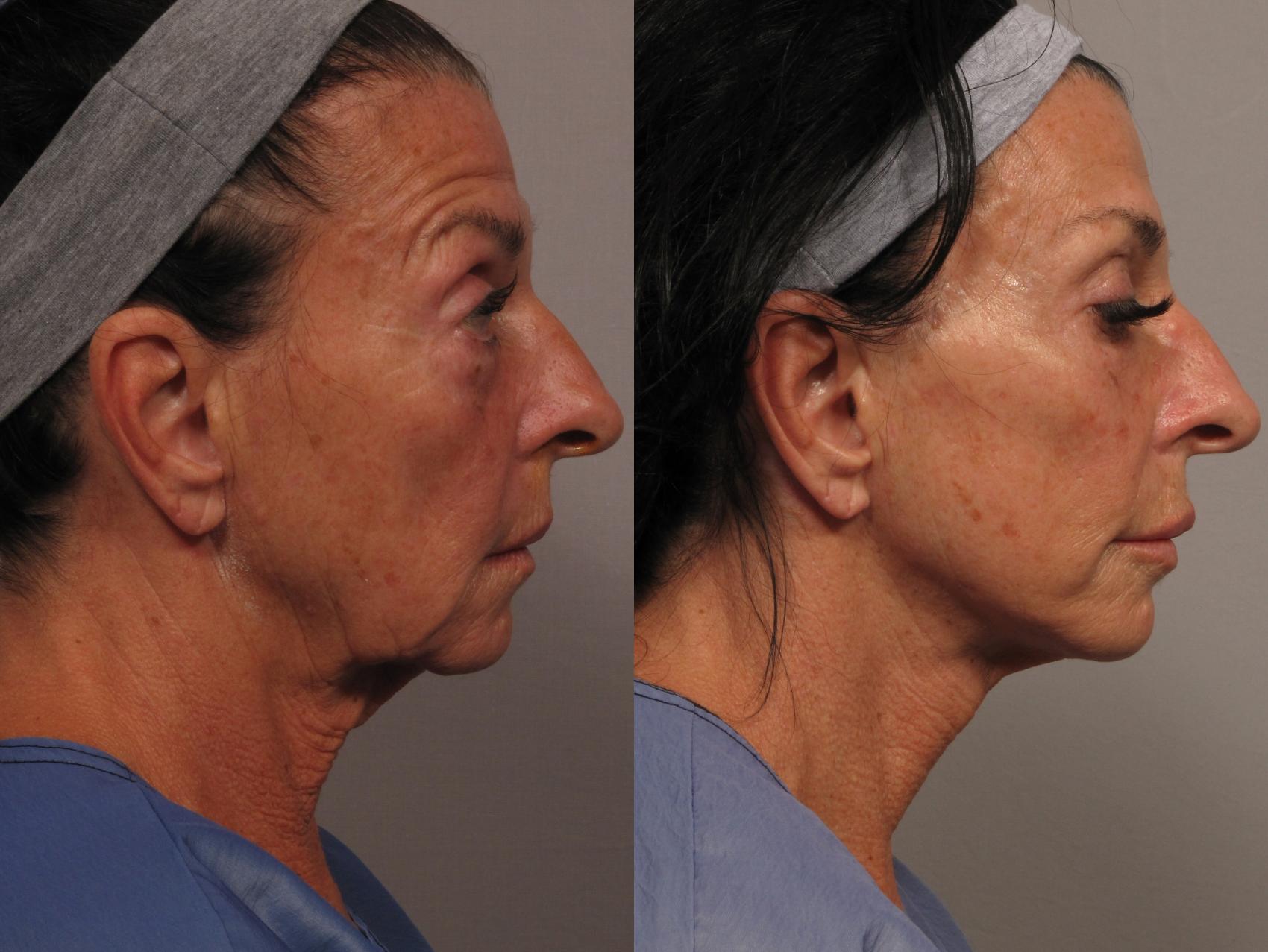 在佛罗里达的那不勒斯，肯特·哈森医生做的面部整容手术前的右侧照片