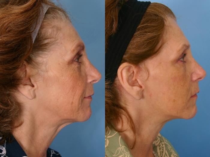 Before & After Facelift Case 41 View #1 View in Naples and Ft. Myers, FL