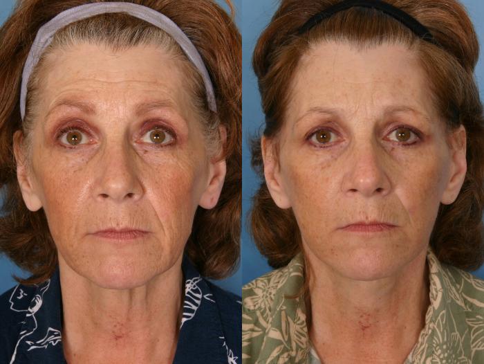 Before & After Facelift Case 41 View #2 View in Naples and Ft. Myers, FL