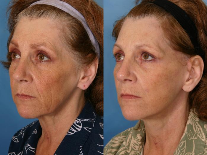Before & After Facelift Case 41 View #3 View in Naples and Ft. Myers, FL