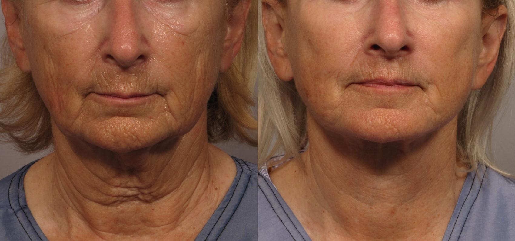 Facelift with Eyelid Lift Frontal View Before and After Photos by Dr. Kent Hasen