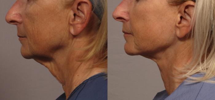 Facelift, Upper Lip Lift and Eyelid Lift Left Side View Before and 8 Months After by Dr. Kent Hasen, Naples, FL