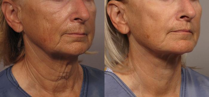 Facelift, Upper Lip Lift and Eyelid Lift Right Oblique View Before and 8 Months After by Dr. Kent Hasen, Naples, FL