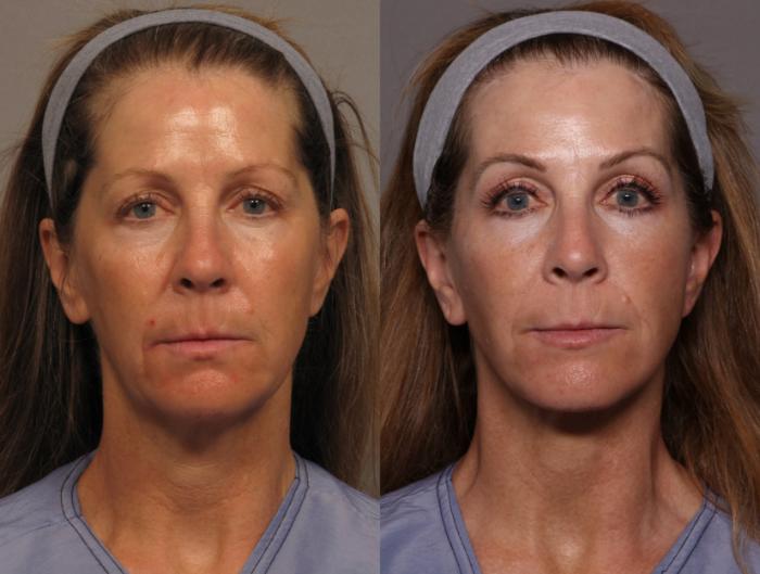 Facelift with Brow Lift, Before and 1 year After Photos, Frontal View, by Dr. Kent Hasen of Naples, Florida