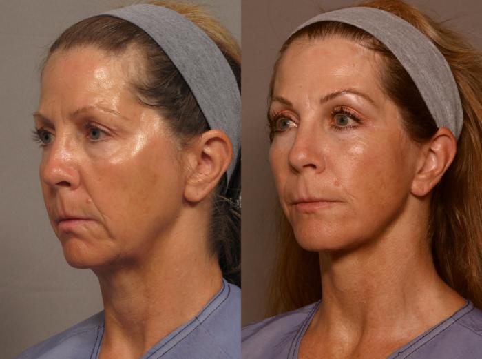 Facelift with Brow Lift, Before and 1 year After Photos, Left Oblique View, by Dr. Kent Hasen of Naples, Florida