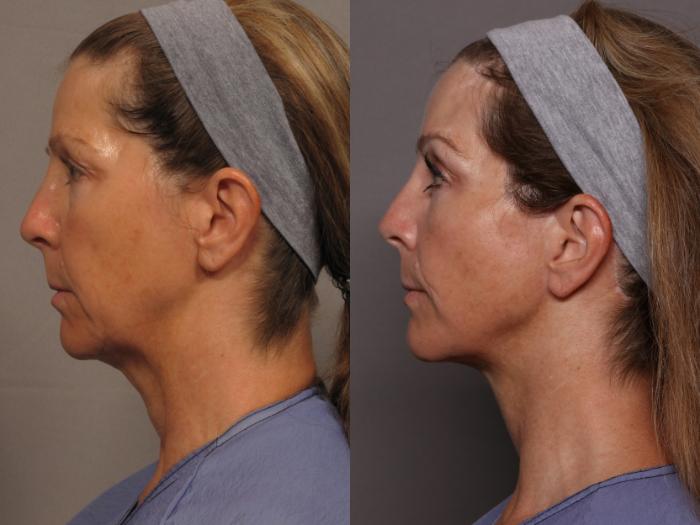 Facelift with Brow Lift, Before and 1 year After Photos, Left Side View, by Dr. Kent Hasen of Naples, Florida