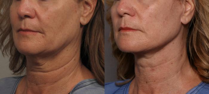 Facelift, Before and After Photos, Left Oblique by Dr. Kent V. Hasen