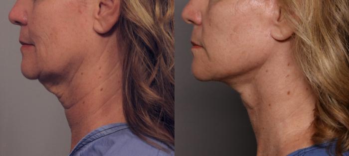 Facelift, Before and After Photos, Left Side by Dr. Kent V. Hasen