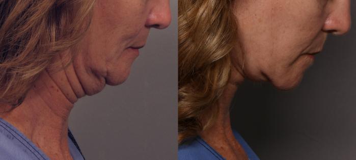 Facelift, Before and After Photos, Right Side Down by Dr. Kent V. Hasen