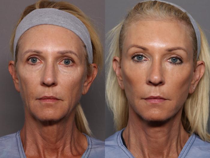 Facelift, Blepharoplasty, and Brow Lift Before and After Photos at 1 year, Frontal View by Dr. Kent Hasen