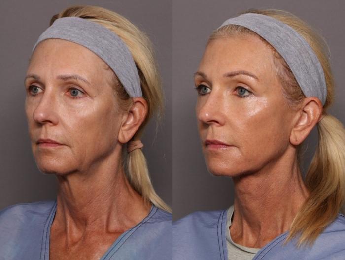 Before & After Eyelid Lift (Blepharoplasty) Case 429 Left Oblique View in Naples and Ft. Myers, FL