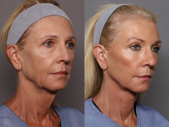 Facelift, Blepharoplasty, and Brow Lift Before and After Photos at 1 year, Right Oblique View by Dr. Kent Hasen