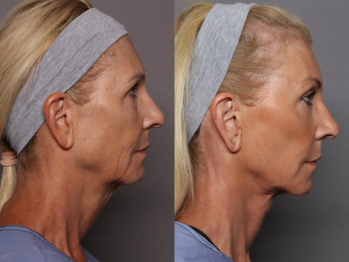 Facelift, Blepharoplasty, and Brow Lift Before and After Photos at 1 year, Rigth Side View by Dr. Kent Hasen
