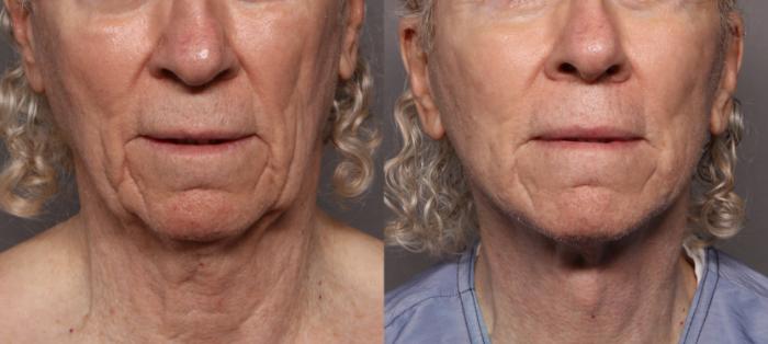 Facelift, Before and After at 3 Months, Frontal View, by Dr. Kent V. Hasen