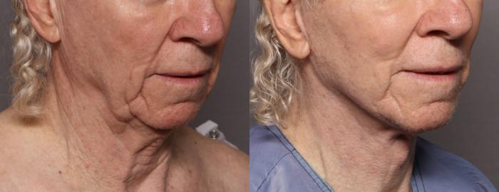 Facelift, Before and After at 3 Months, Right Oblique View, by Dr. Kent V. Hasen