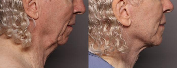 Facelift, Before and After at 3 Months, Right Side View, by Dr. Kent V. Hasen
