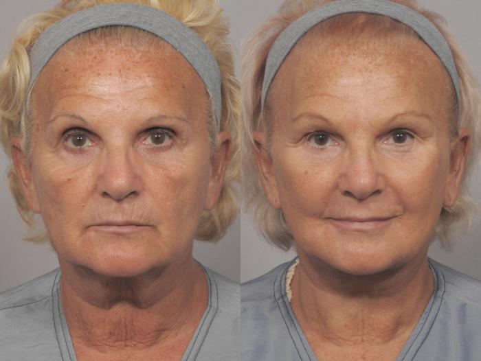 Facelift, Browlift and Fat Grafting, Before and After Photos, 1 Year Post Op, Frontal View by Dr. Kent Hasen