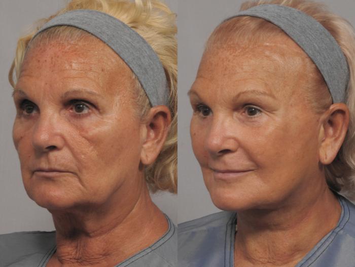 Facelift, Browlift and Fat Grafting, Before and After Photos, 1 Year Post Op, Left Oblique View by Dr. Kent Hasen