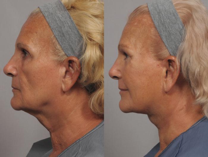Facelift, Browlift and Fat Grafting, Before and After Photos, 1 Year Post Op, Left Side View by Dr. Kent Hasen