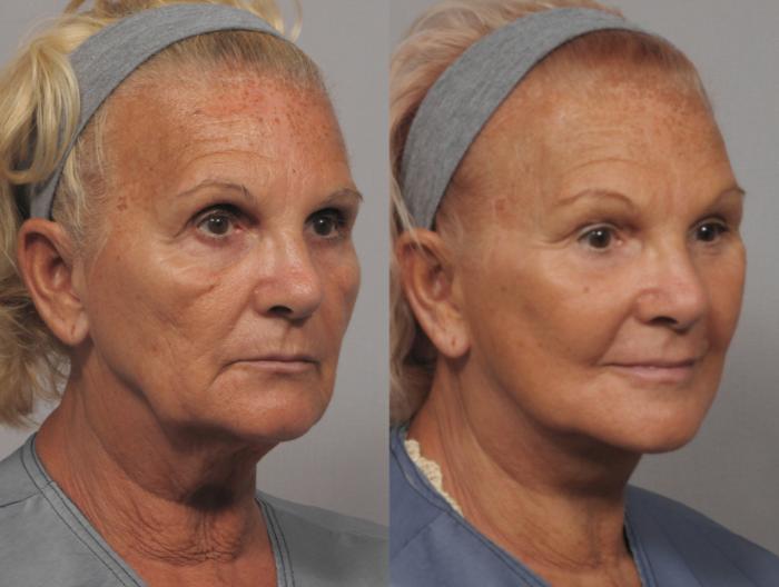 Facelift, Browlift and Fat Grafting, Before and After Photos, 1 Year Post Op, Right Oblique View by Dr. Kent Hasen
