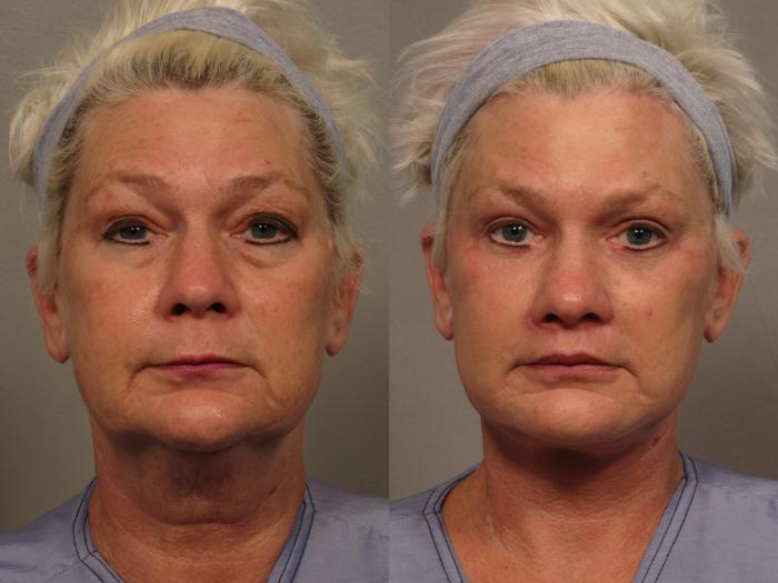 Frontal View of Total Facial Rejuvenation with Facelift, Brow and Eyelid lift, Before and After at 3 months, by Dr. Hasen