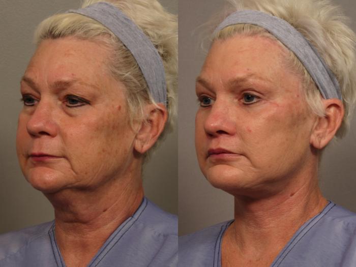 Left Oblique View of Total Facial Rejuvenation with Facelift, Brow and Eyelid lift, Before and After at 3 months, by Dr. Hasen