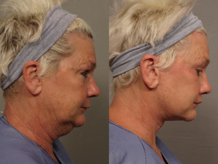 Right Side View of Total Facial Rejuvenation with Facelift, Brow and Eyelid lift, Before and After at 3 months, by Dr. Hasen