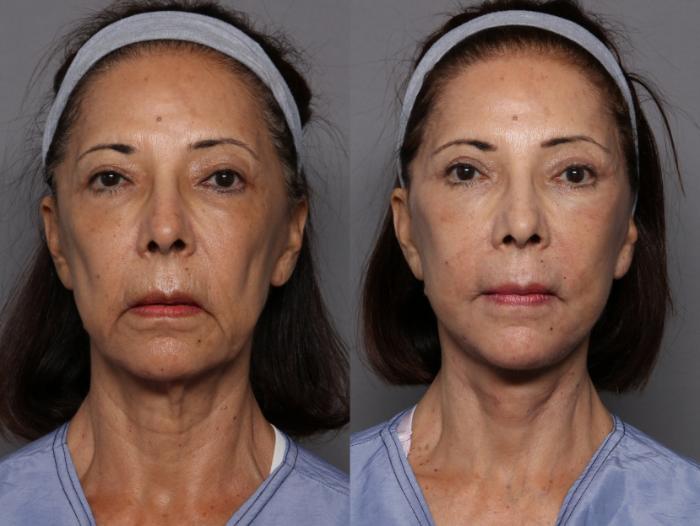 Facelift and Upper Eyelid Lift, Frontal View, Before and After at 3 Months by Kent V. Hasen, MD